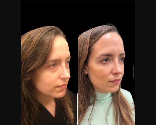 Facial Fat Transfer Before & After Gallery - Patient 277580 - Image 1