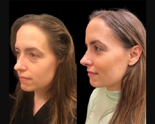 Facial Fat Transfer Before & After Gallery - Patient 277580 - Image 2
