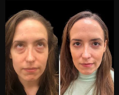 Facial Fat Transfer Before & After Gallery - Patient 277580 - Image 3