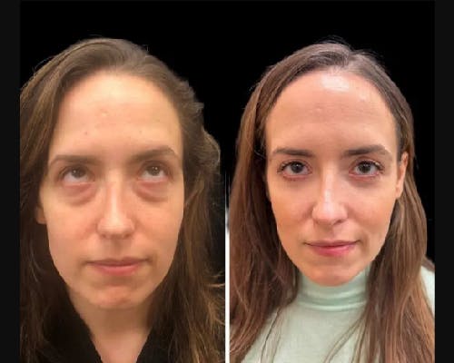 Facial Fat Transfer Before & After Gallery - Patient 277580 - Image 3