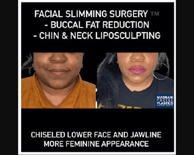 Facial Slimming Surgery Before & After Gallery - Patient 290053 - Image 2
