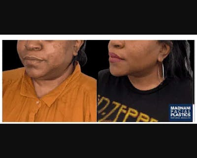 Facial Slimming Surgery Before & After Gallery - Patient 290053 - Image 3