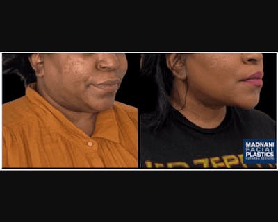 Facial Slimming Surgery Before & After Gallery - Patient 290053 - Image 4