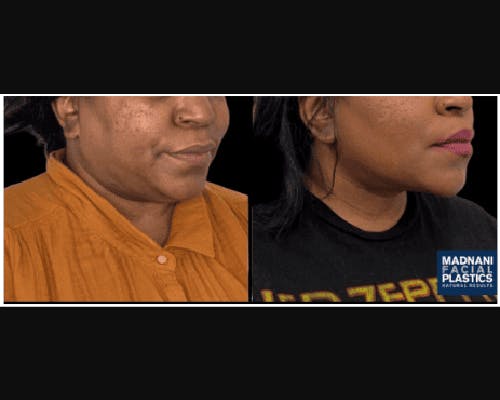 Facial Slimming Surgery Before & After Gallery - Patient 290053 - Image 4