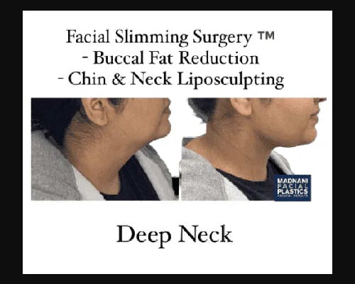 Facial Slimming Surgery Before & After Gallery - Patient 299148 - Image 2