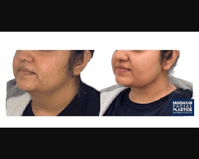 Facial Slimming Surgery Before & After Gallery - Patient 299148 - Image 3