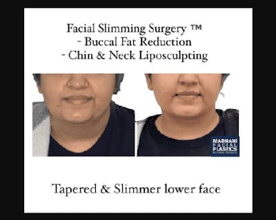 Facial Slimming Surgery Before & After Gallery - Patient 299148 - Image 4