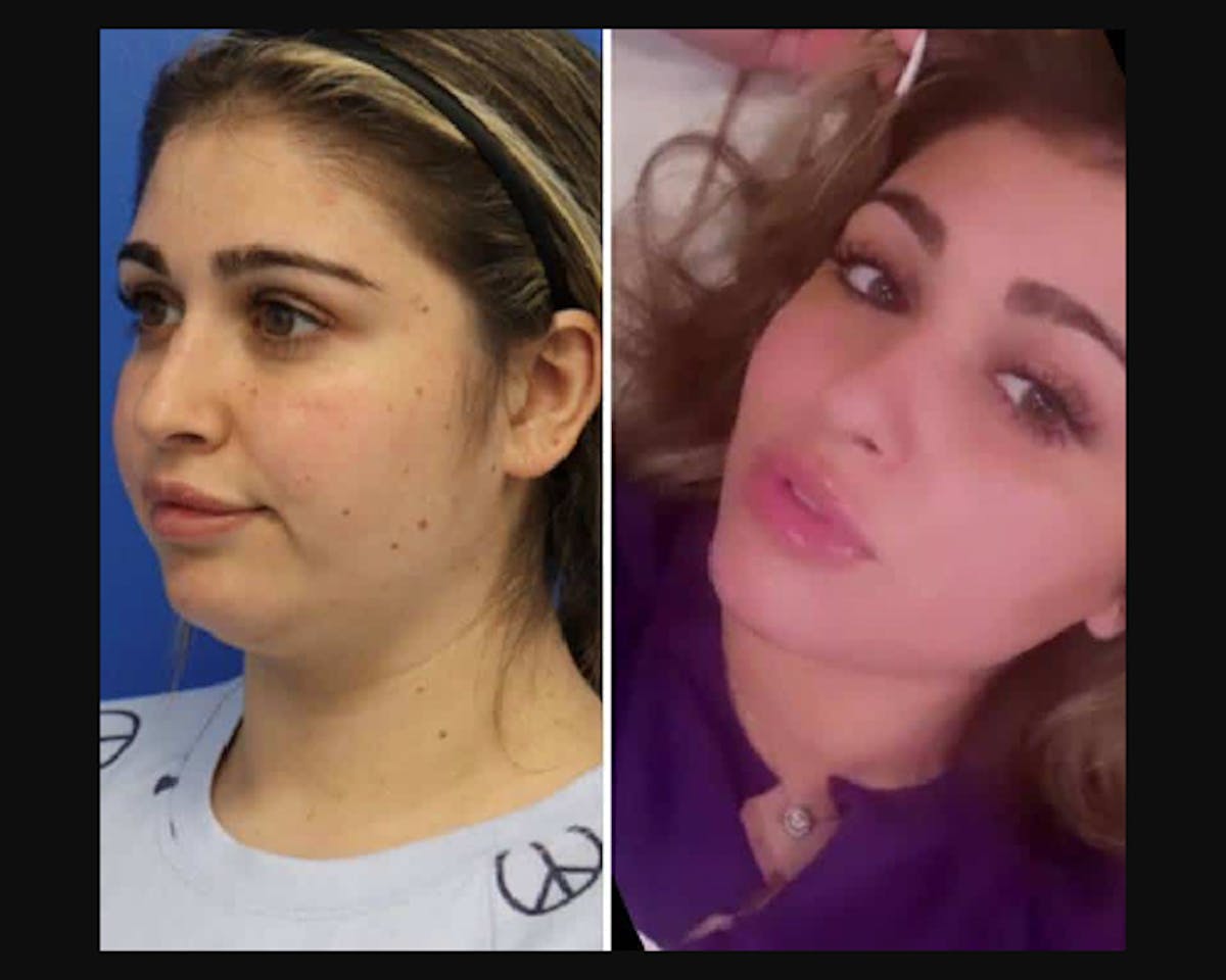 before and after facial slimming procedure