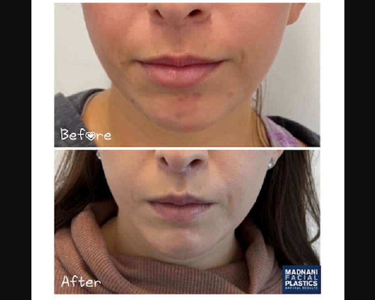 lip lift results