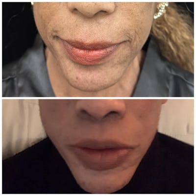 lip lift results