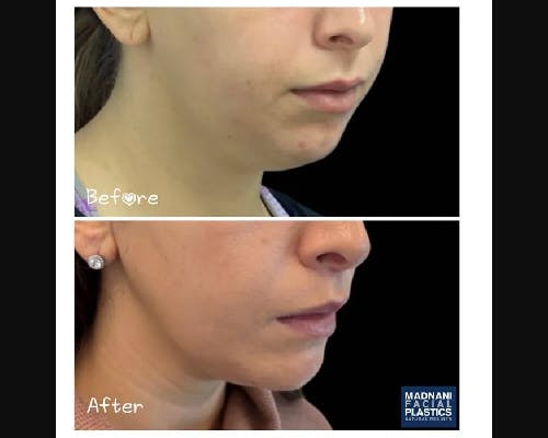 Chin Implants