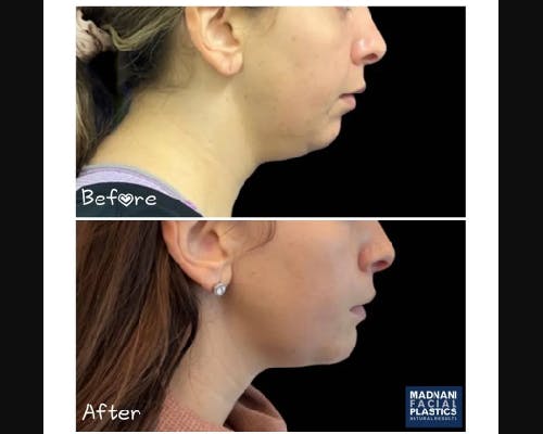 Chin Implants