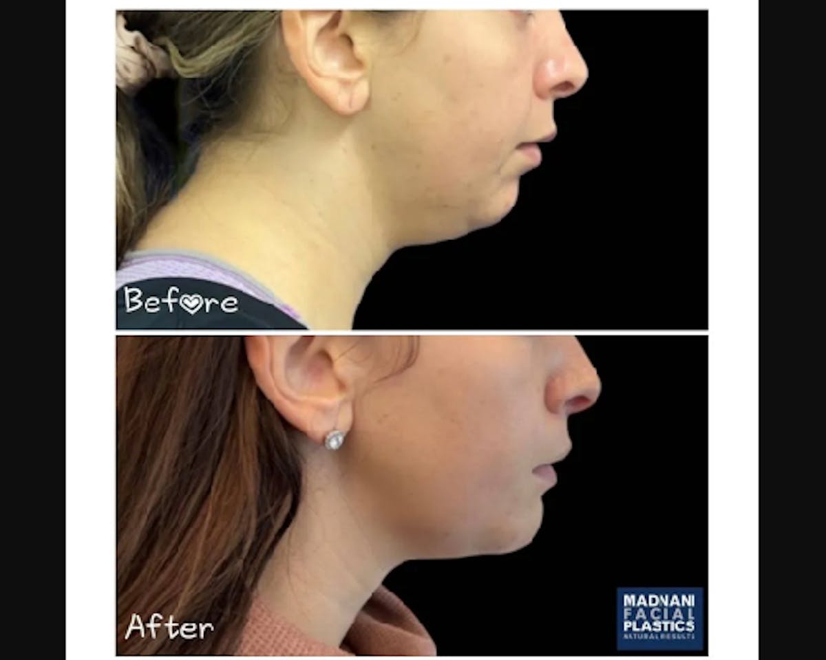Chin Implant Before & After Gallery - Patient 304145 - Image 2