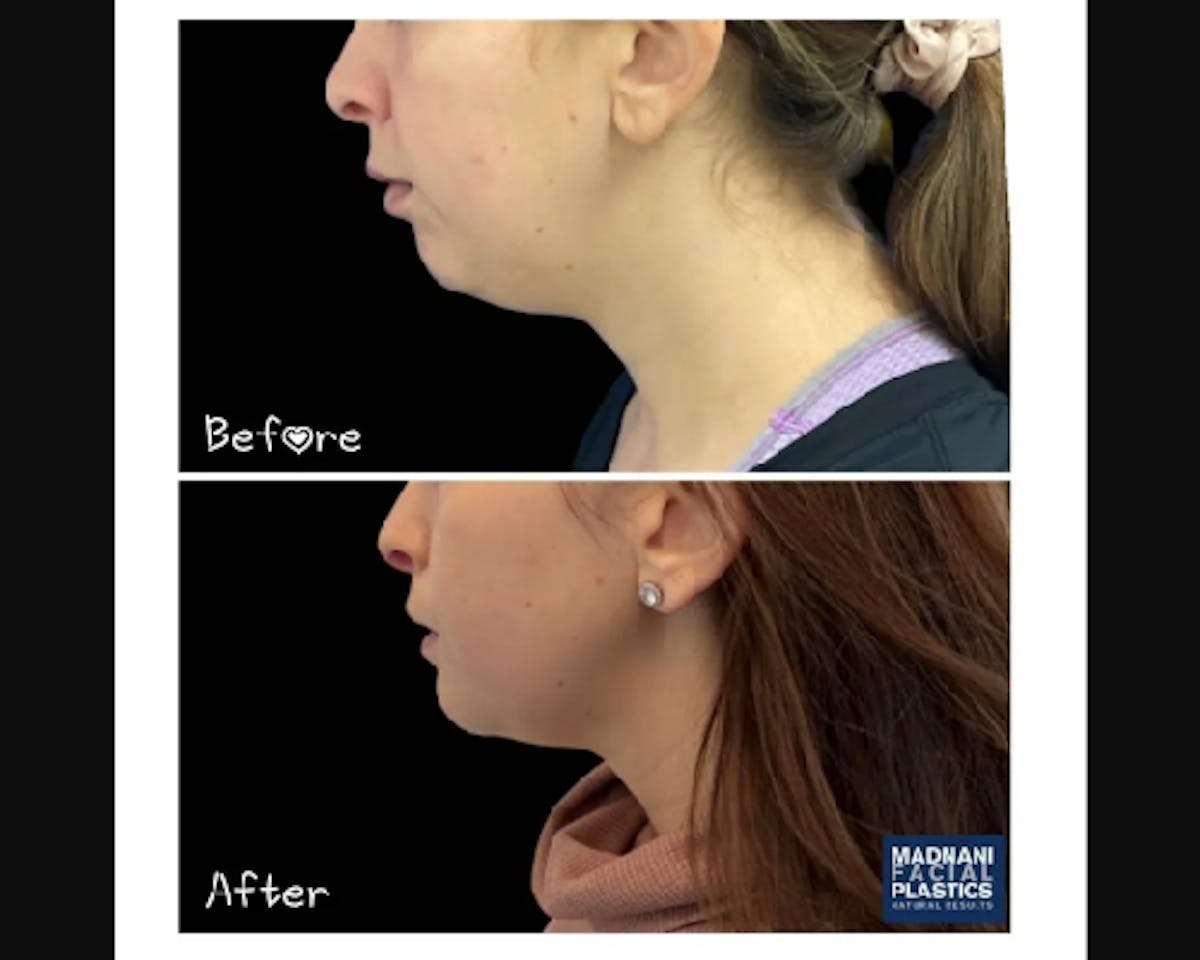 Chin Implant Before & After Gallery - Patient 304145 - Image 3