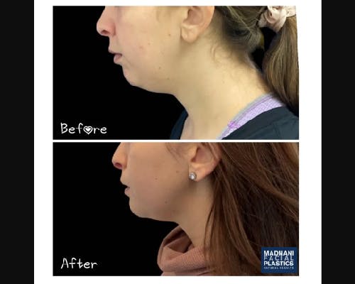 Chin Implant Before & After Gallery - Patient 304145 - Image 3