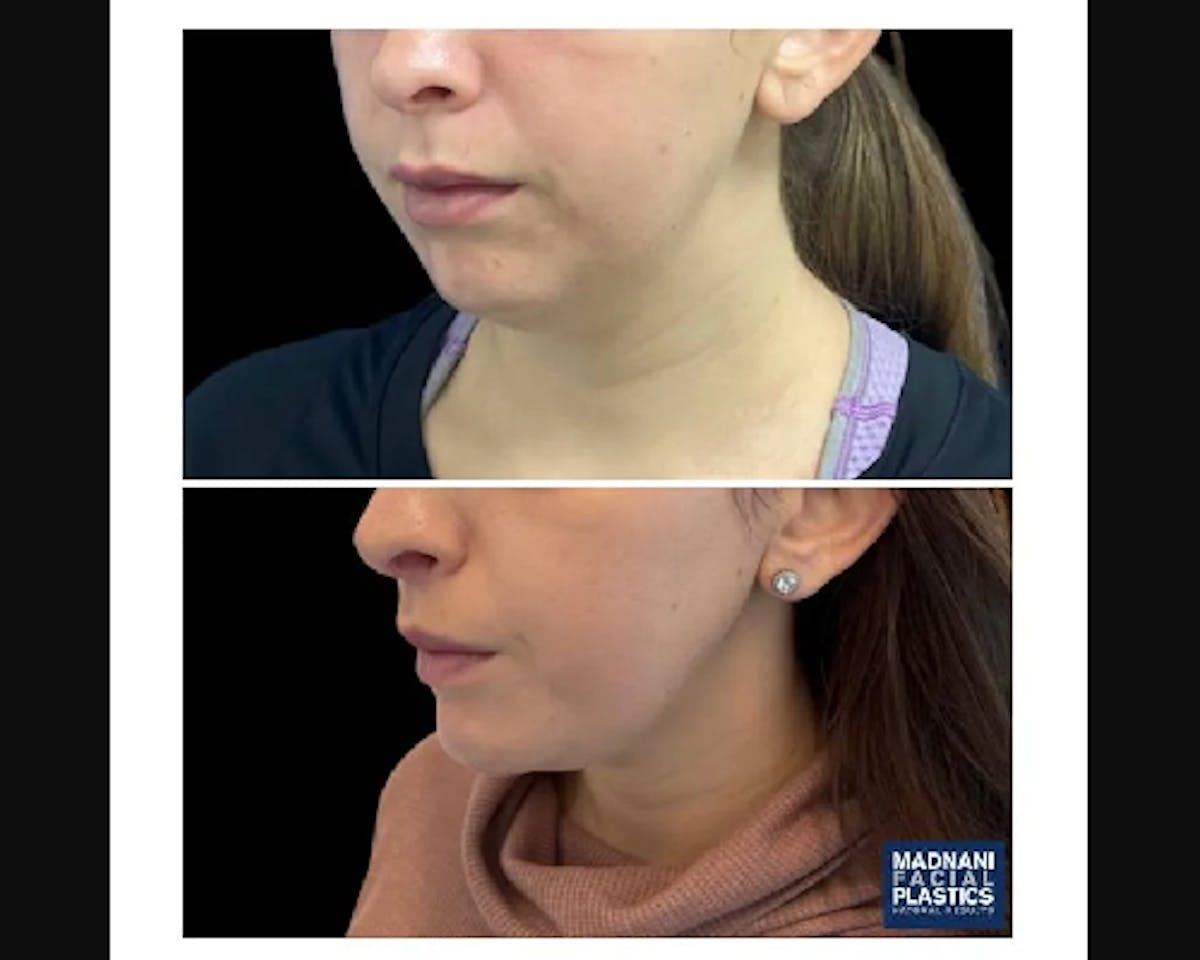 Chin Implant Before & After Gallery - Patient 304145 - Image 4