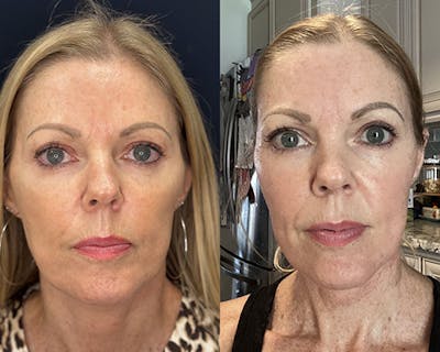 CO2 Laser Face Resurfacing Before & After Gallery - Patient 320129 - Image 1