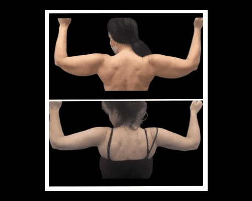 arm lift patient results