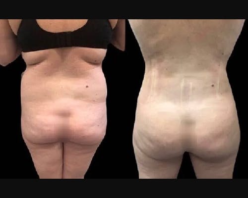 BBL Before & After Gallery - Patient 275694 - Image 1