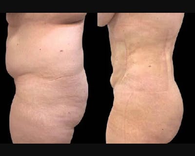 BBL Before & After Gallery - Patient 275694 - Image 2