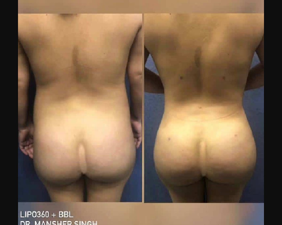  BBL Before & After Gallery - Patient 320262 - Image 1