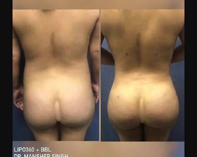 BBL Before & After Gallery - Patient 320262 - Image 1