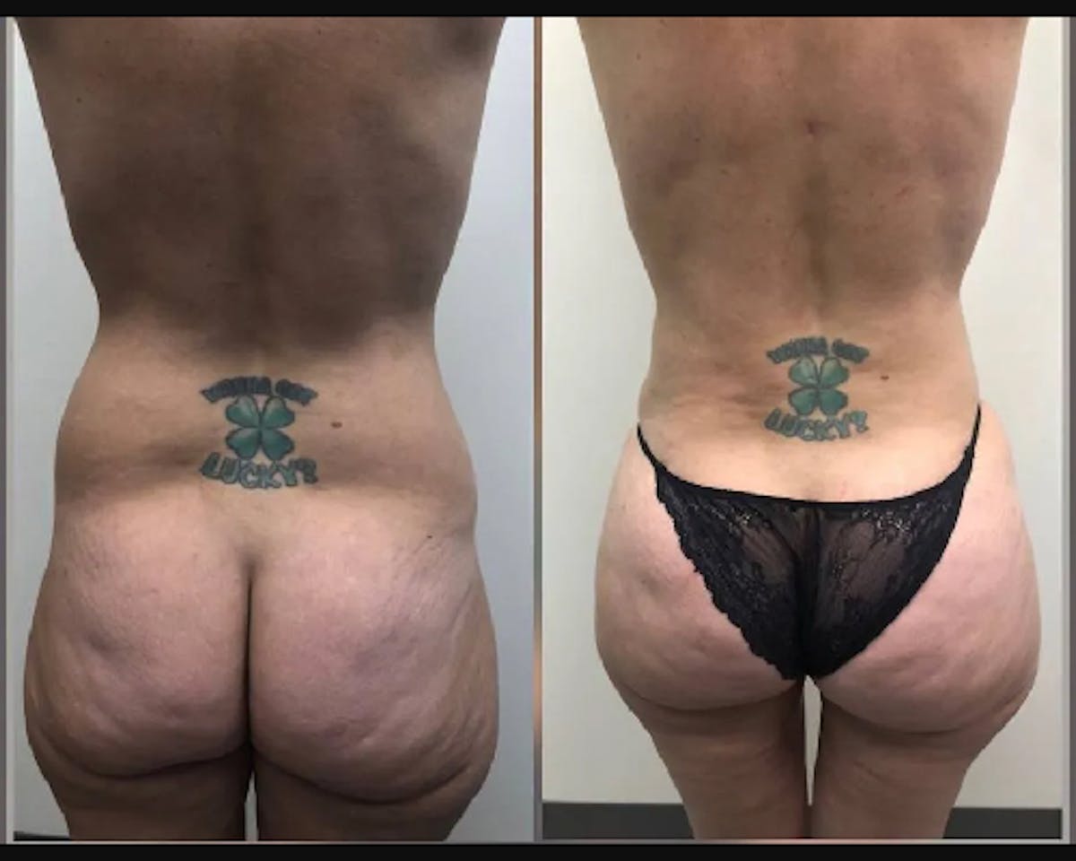  BBL Before & After Gallery - Patient 833417 - Image 1
