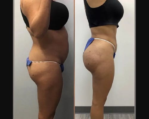 BBL Before & After Gallery - Patient 372252 - Image 1