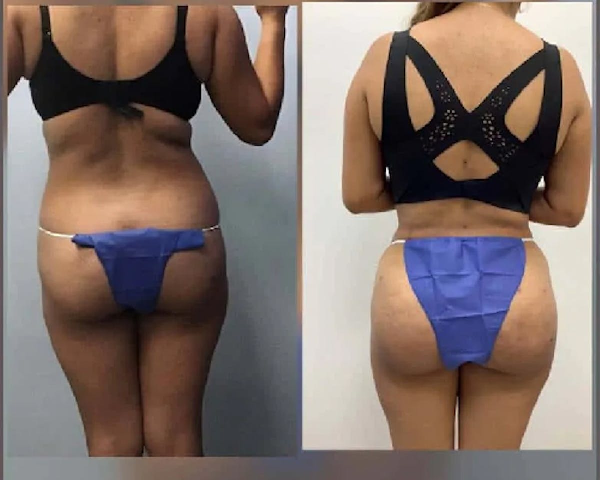  BBL Before & After Gallery - Patient 372252 - Image 2