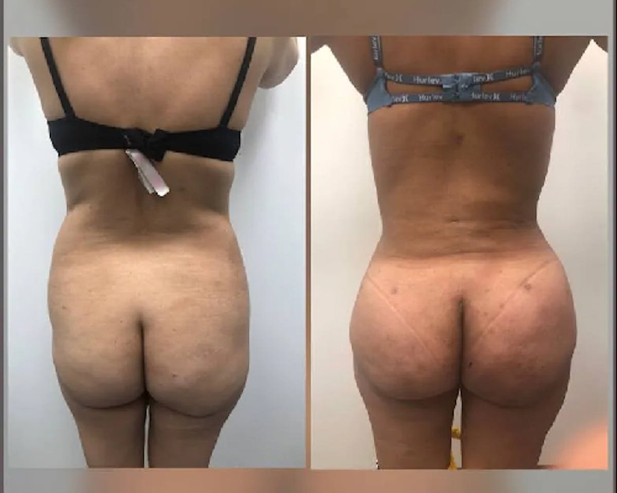  BBL Before & After Gallery - Patient 349436 - Image 1