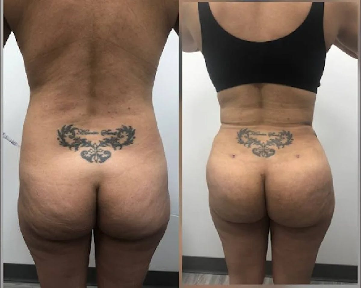  BBL Before & After Gallery - Patient 279328 - Image 1