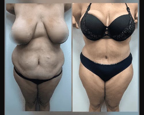 Tummy Tuck Before & After Gallery - Patient 470465 - Image 1