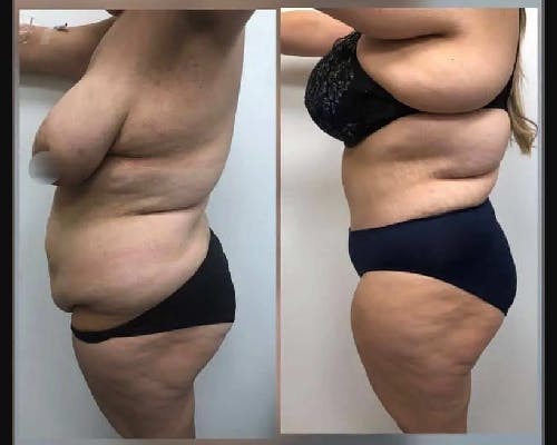 Tummy Tuck Before & After Gallery - Patient 470465 - Image 2