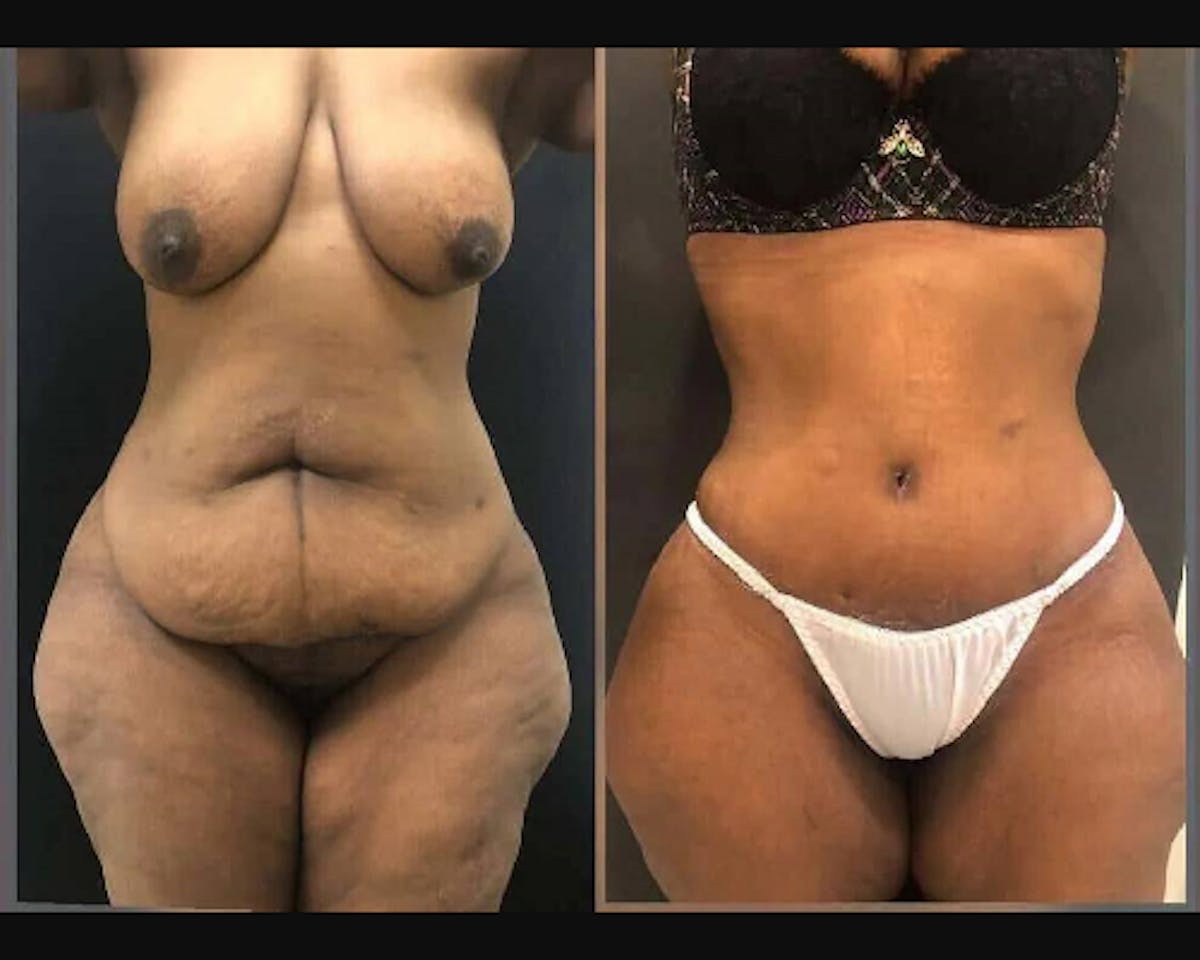 Tummy Tuck Before & After Gallery - Patient 791317 - Image 1