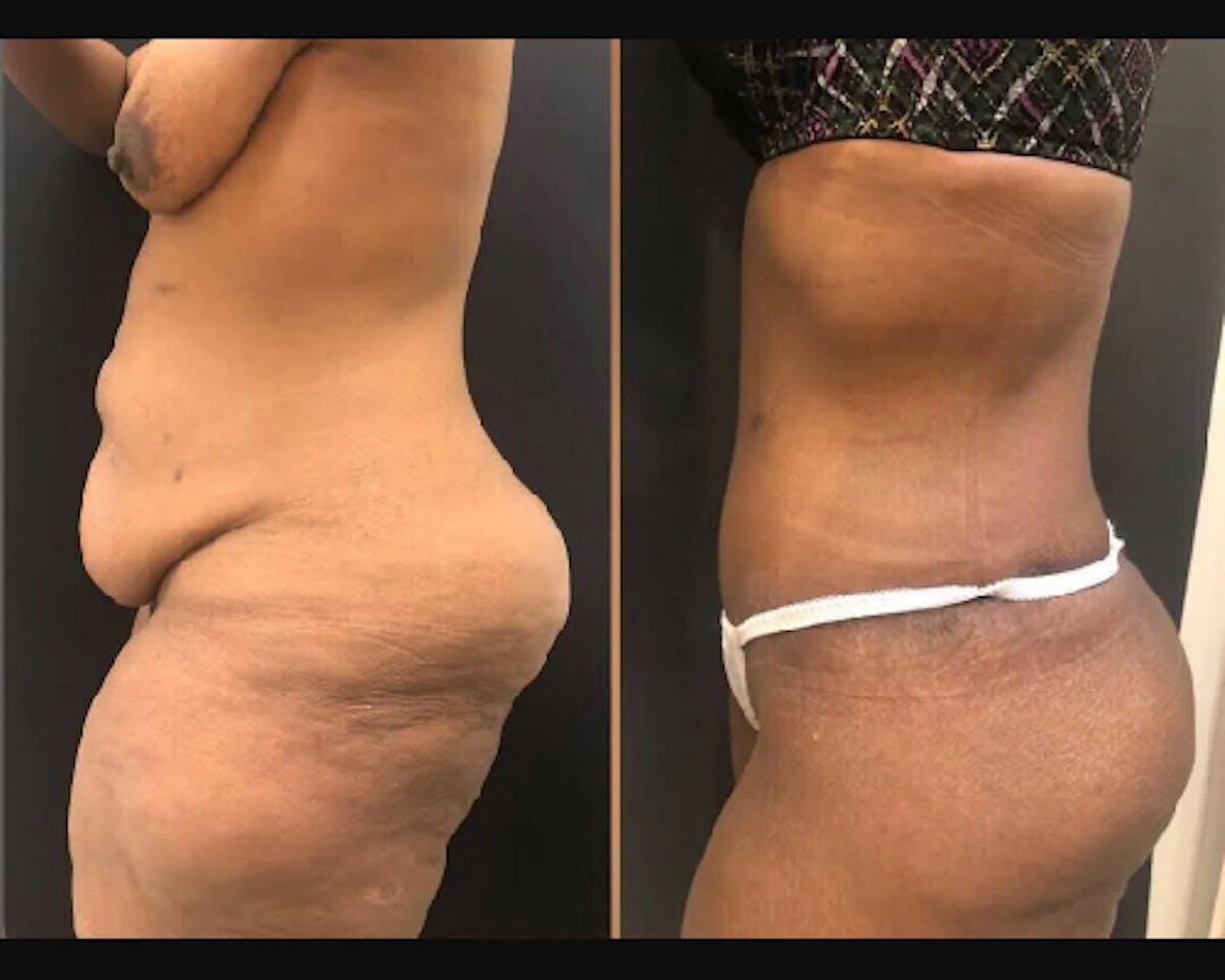 Tummy Tuck Before & After Gallery - Patient 791317 - Image 2