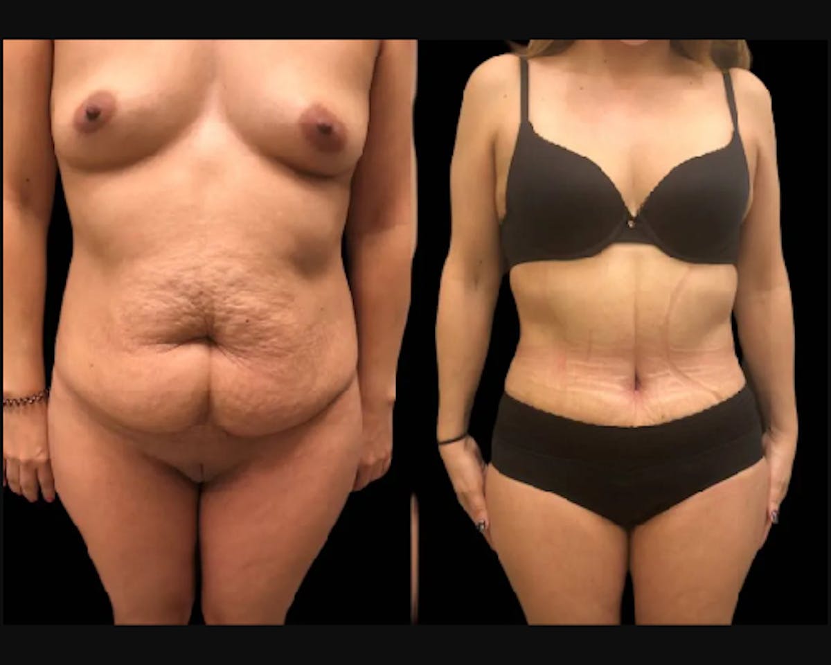 Tummy Tuck Before & After Gallery - Patient 452235 - Image 1
