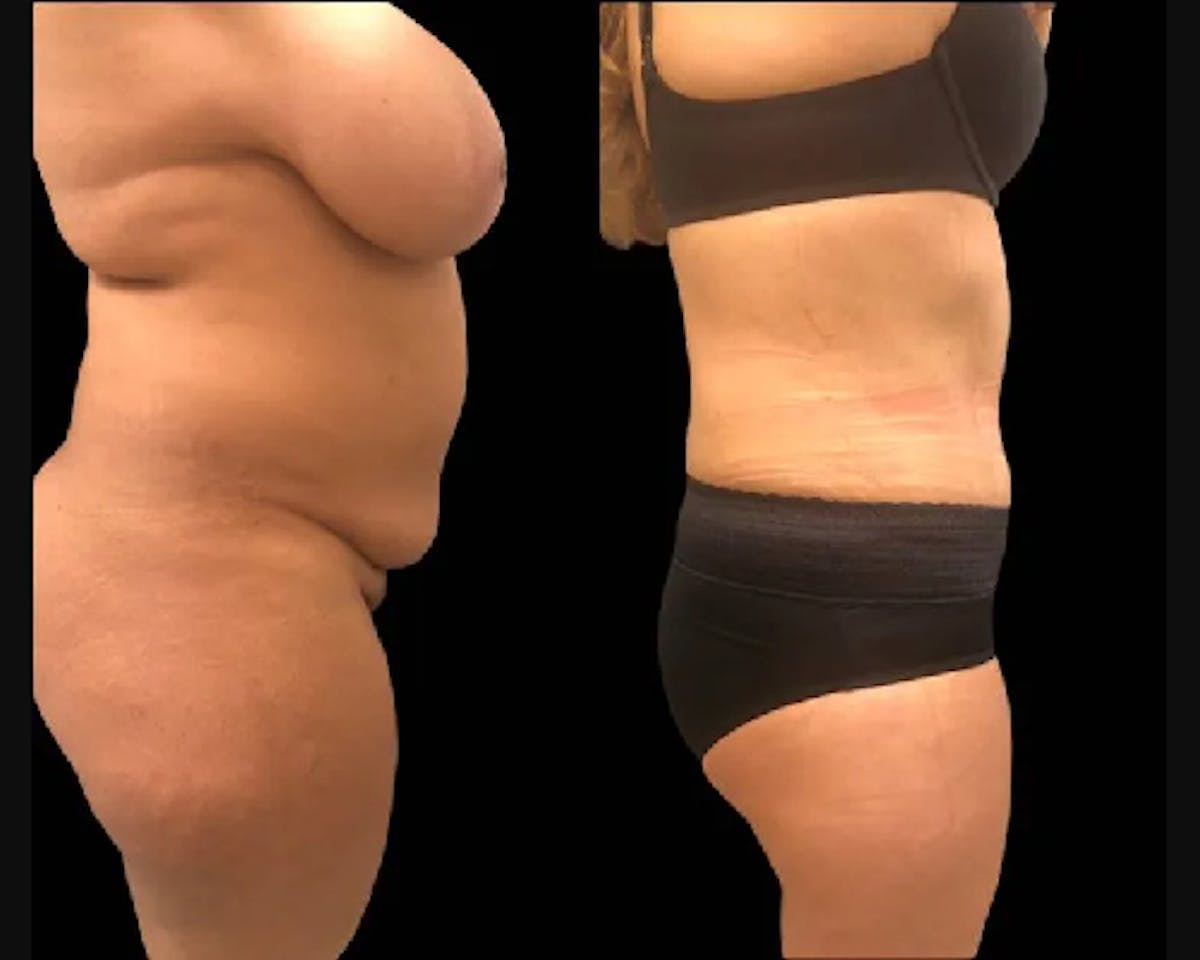 Tummy Tuck Before & After Gallery - Patient 452235 - Image 2