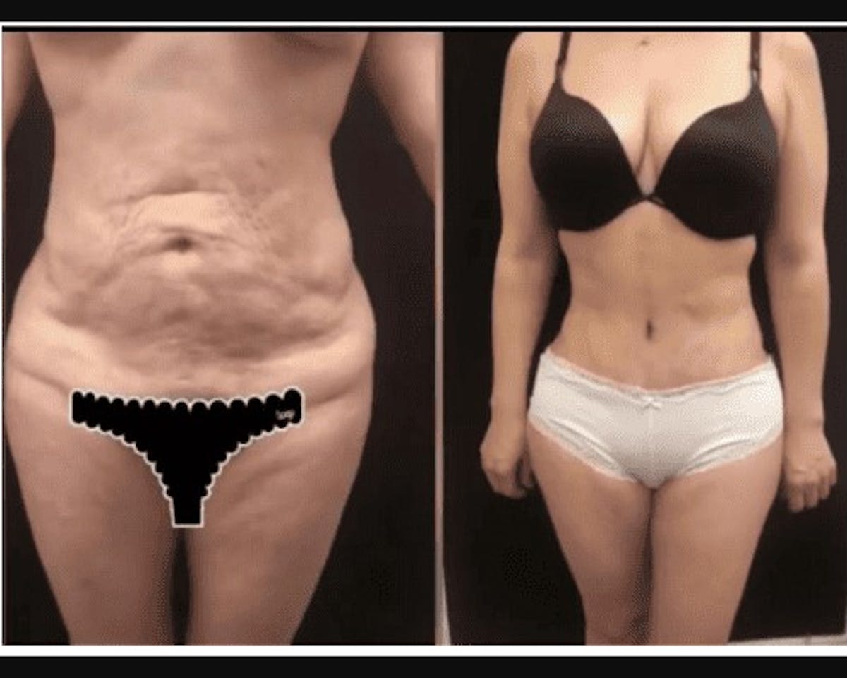 Tummy Tuck Before & After Gallery - Patient 375221 - Image 1