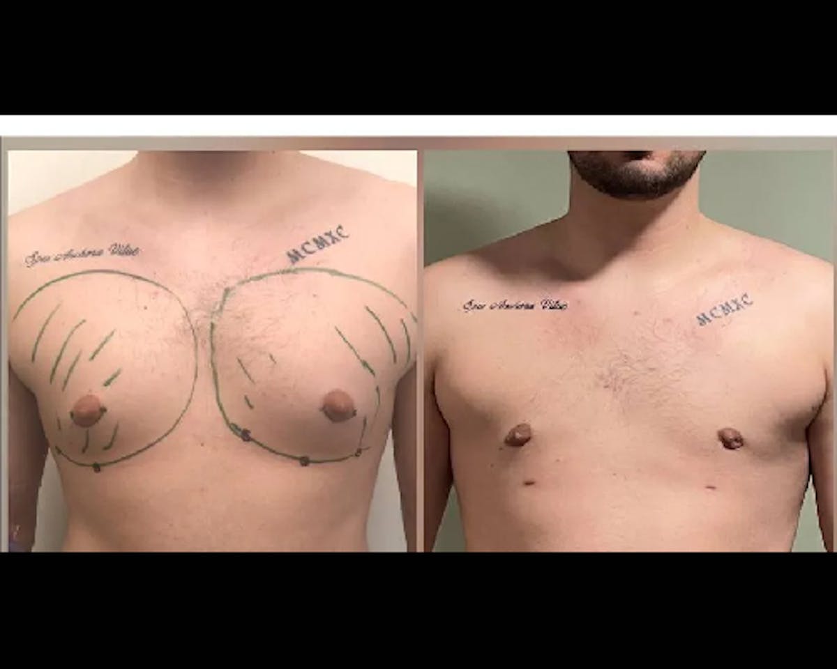 Gynecomastia Before & After Gallery - Patient 373407 - Image 1