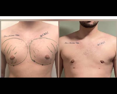 Gynecomastia Before & After Gallery - Patient 373407 - Image 1
