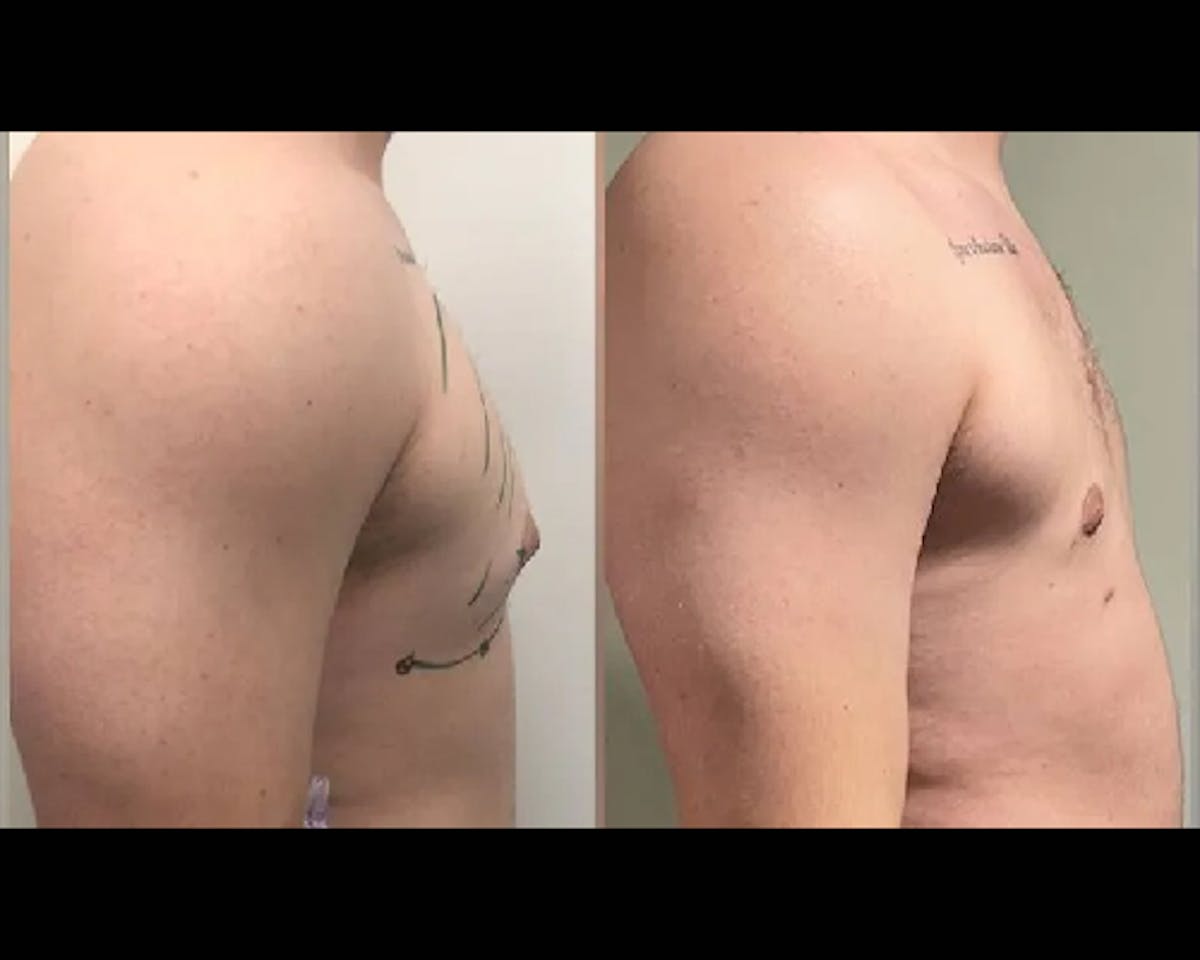 Gynecomastia Before & After Gallery - Patient 373407 - Image 2