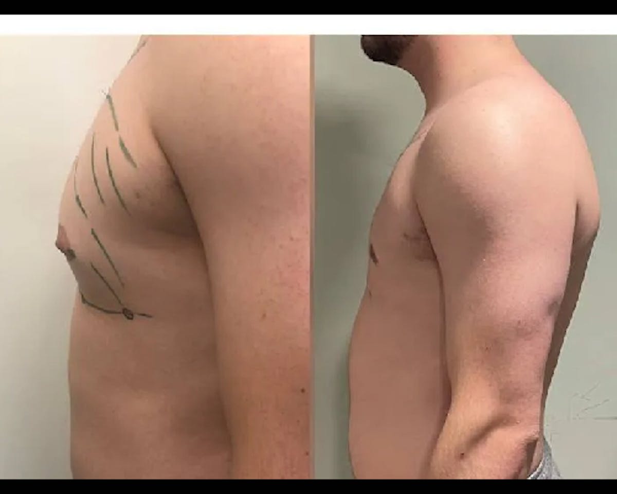 Gynecomastia Before & After Gallery - Patient 373407 - Image 3