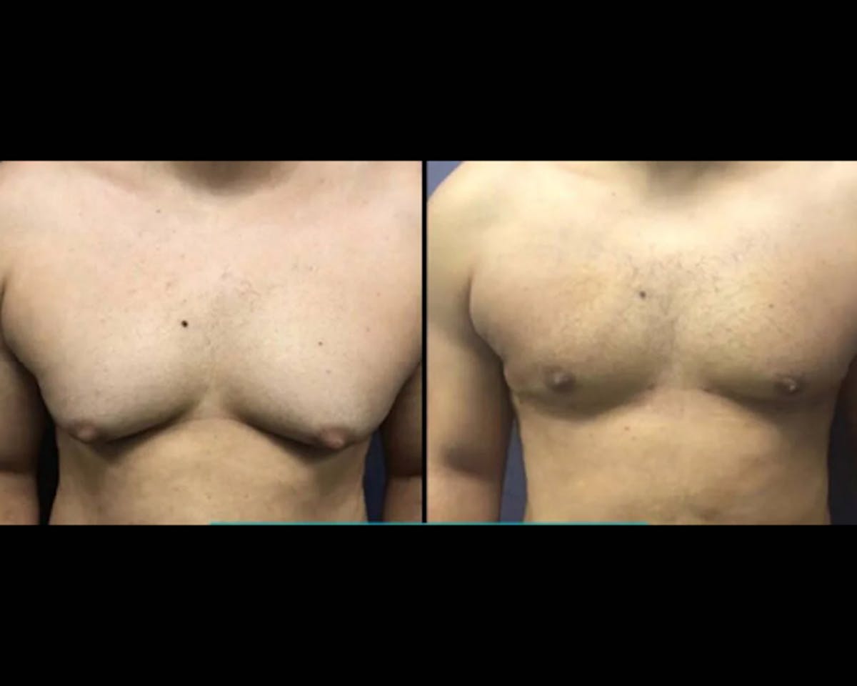 Gynecomastia Before & After Gallery - Patient 194006 - Image 1