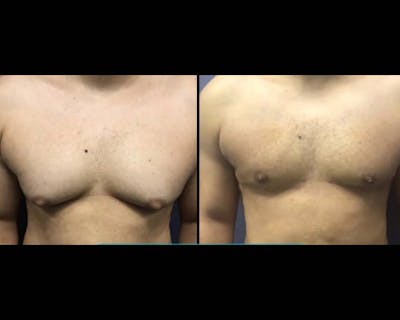Gynecomastia Before & After Gallery - Patient 194006 - Image 1
