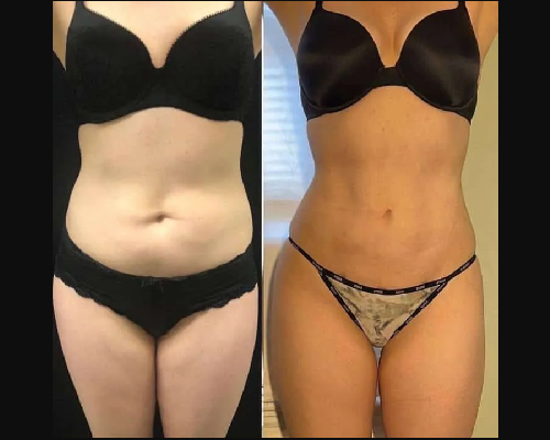 liposuction patient results
