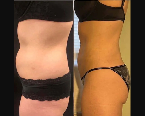 liposuction patient results