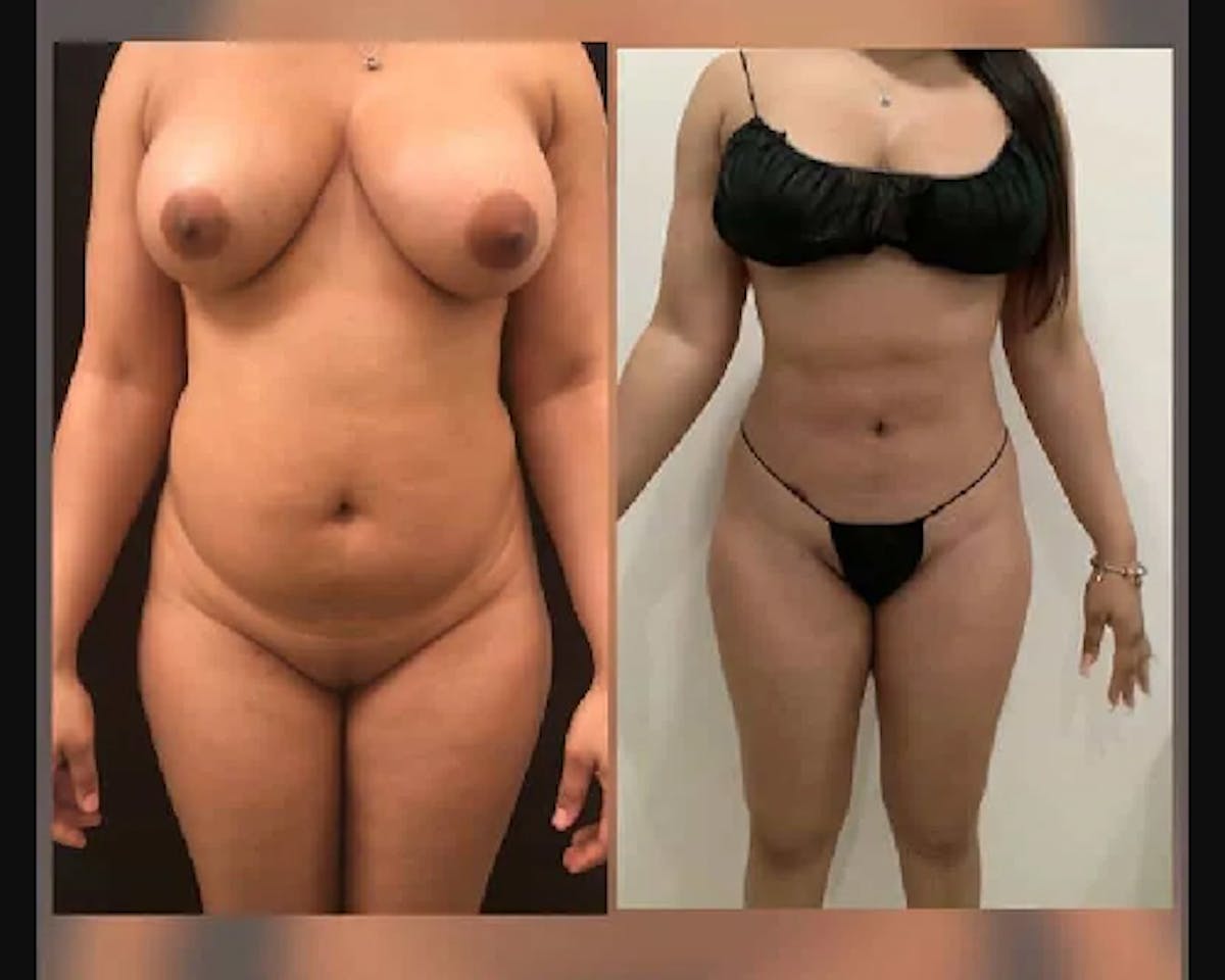 Liposuction Before & After Gallery - Patient 214532 - Image 1
