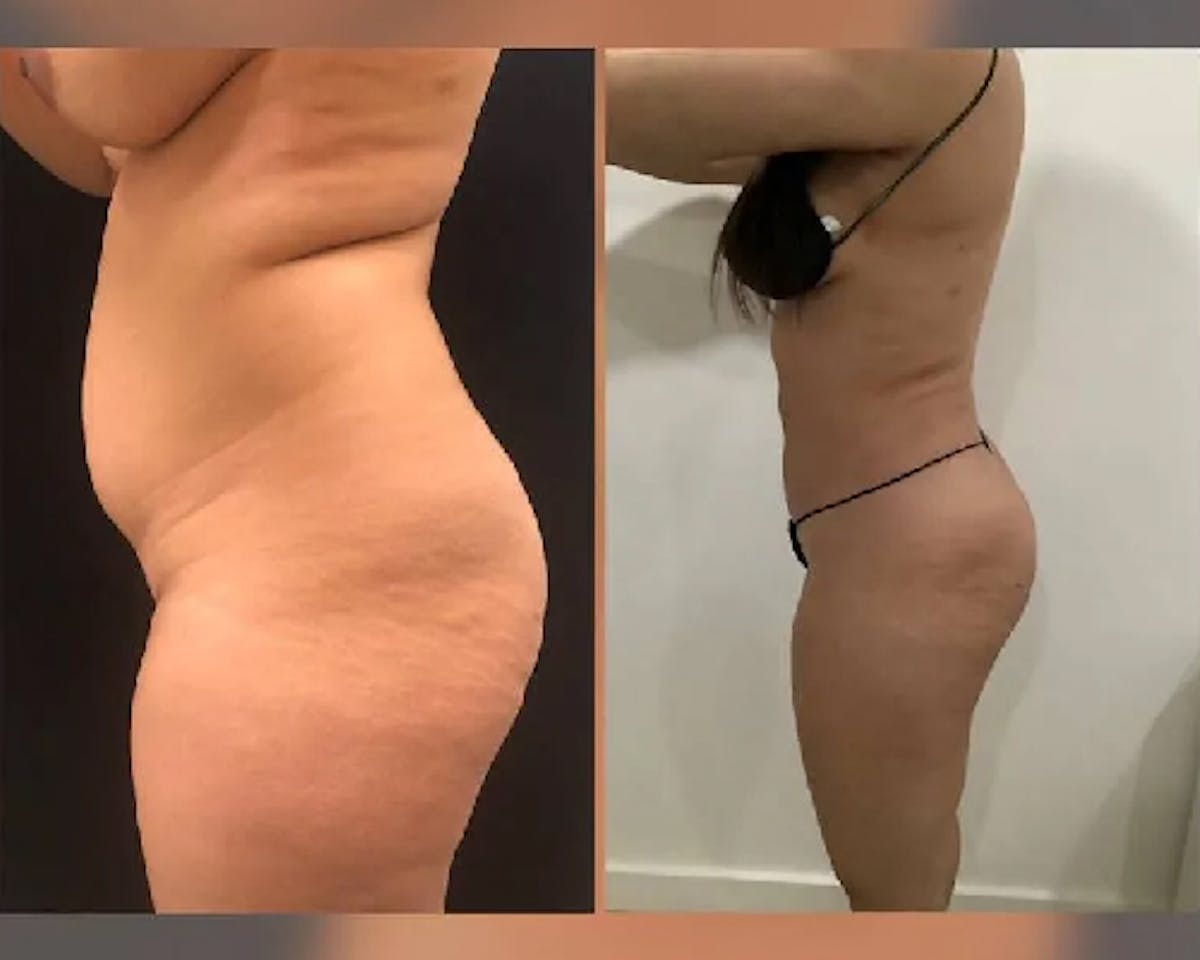 Liposuction Before & After Gallery - Patient 214532 - Image 2