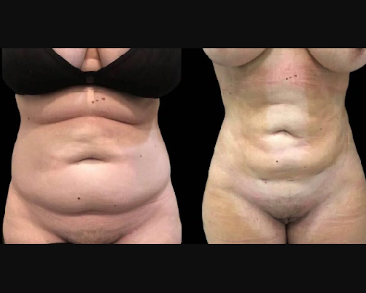 Liposuction Before & After Gallery - Patient 481062 - Image 1
