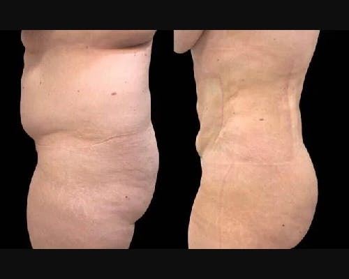 Liposuction Before & After Gallery - Patient 481062 - Image 2